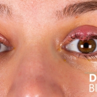 Demodex Blepharitis