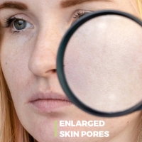 Enlarged Skin Pores